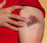 מחלות דם: כשהגוף תוקף את עצמו-תמונה